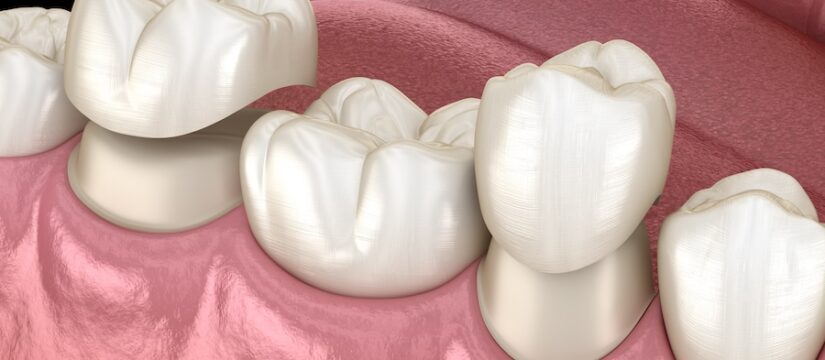 same-day restorative dentistry, dental crowns Liberty MO, Seaport Family Dentistry, same-day crowns, CEREC crowns